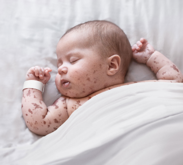 Baby with a promonent red rash, sleeping in a bed